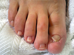 The toenail before fixing